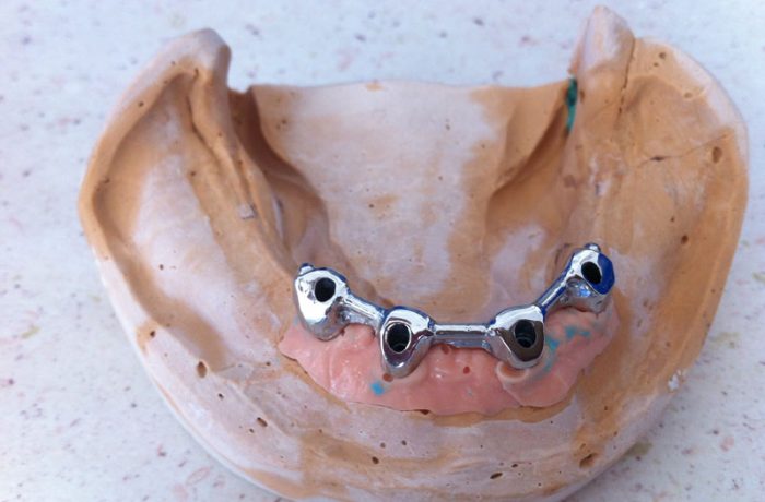 Prótesis sobreimplantes