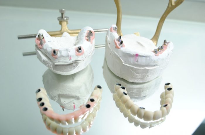 Sobreimplantes
