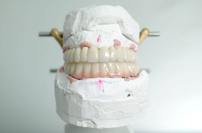 Sobreimplantes
