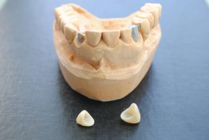 Sobreimplantes