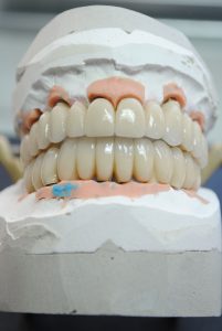 Sobreimplantes