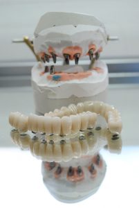 Sobreimplantes