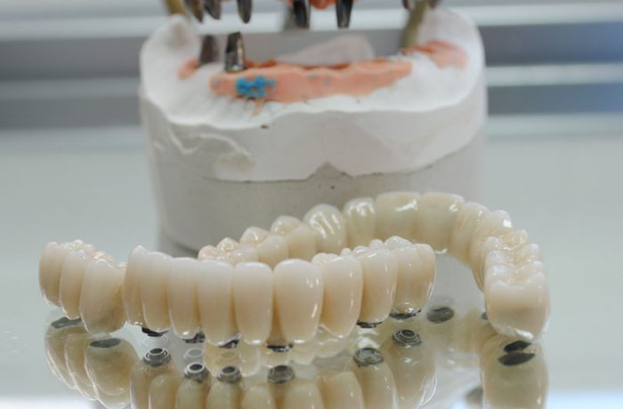 Sobreimplantes