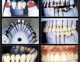 Prótesis sobre implantes