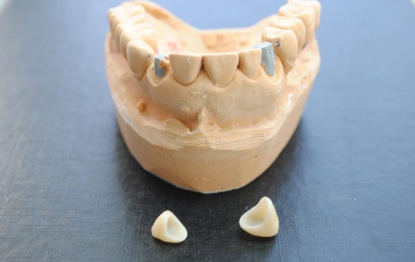 Sobreimplantes