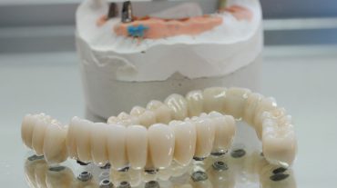 Sobreimplantes