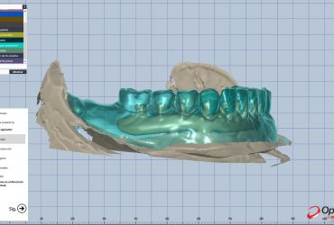 Casos cad-cam