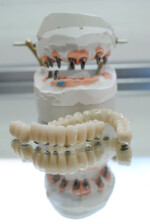 Sobreimplantes